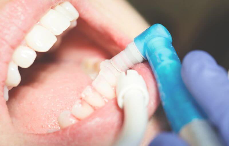 Limpieza dental profesional en Cali para eliminar placa y sarro