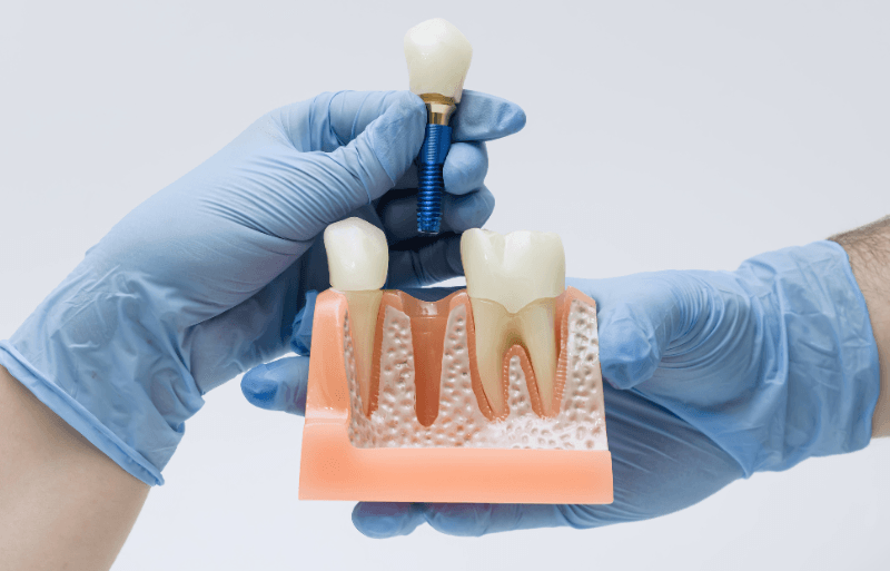 Procedimiento de injerto óseo dental para recuperar hueso perdido